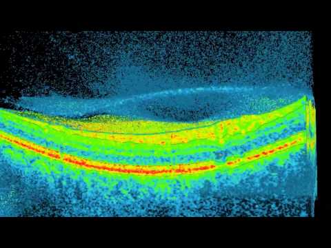 What are floaters in front of my eyes? Vitreous degeneration.