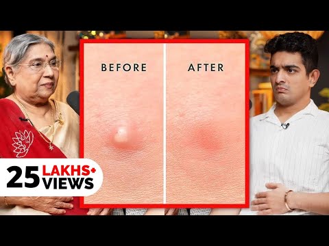 Fastest Pimple Healing Exercise & Hacks Explained - Yoga For Clear Skin