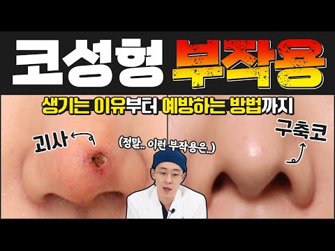 전문의가 알려주는 코성형 부작용!! (코성형 생각있으신분들 꼭 보세요) #구축코 #성형부작용 #코재수술