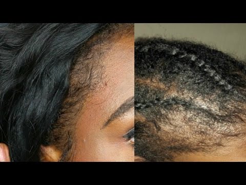 Natural Hair| 5 Tips How to REGROW  balding or thinning 4C EDGES