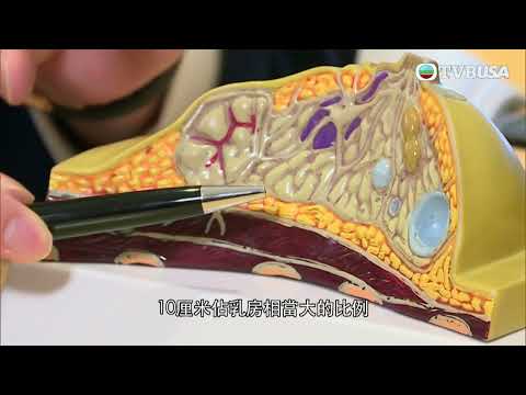 東張西望｜一名女子乳房發現細小組織，豈料進行微創手術後竟發現自己大半邊乳房被切去！詳情怎樣？