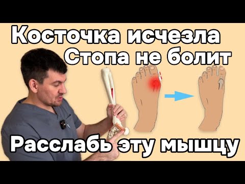 Косточка на большом пальце стопы исчезает навсегда. Нужно расслабить эту мышцу. Причина в ней