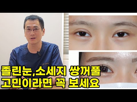 졸린눈 소세지쌍꺼풀 재수술 고민이라면 꼭 보세요(눈매교정,쌍꺼풀 작게 만들기)