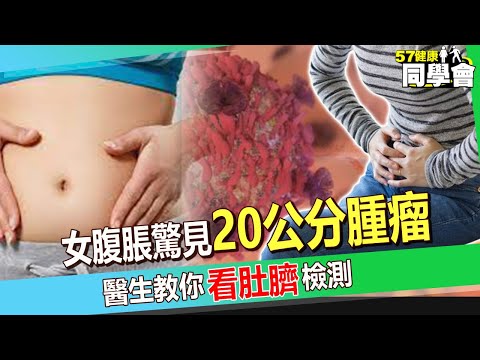 【精選】50歲媽腹痛腹脹驚見20公分腫瘤！7成卵巢癌末期才發現？！醫生教你1招看肚臍檢測！【 @57healthy 】