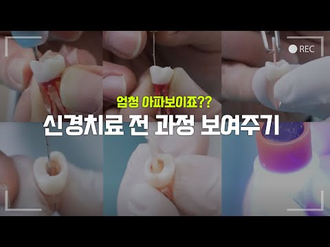 신경치료 과정 처음부터 끝까지 직접 보여드립니다