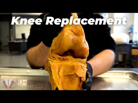 Is KNEE REPLACEMENT the MOST PAINFUL surgery ever?