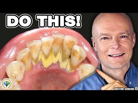 #1 Absolute Best Way to Stop Tartar