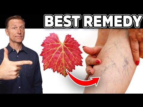 Venous Insufficiency: This is the Most Effective and Safest Remedy for Varicose Veins