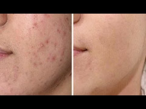 Вернется ли АКНЕ после РОАККУТАНА?  % рецидивов (возвращения угрей) после курса ретиноидов