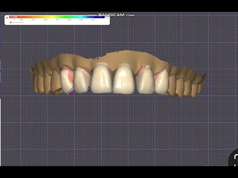 Exocad’te Monolitik Ön 6 Üye Tasarımı | Bu Detayı Kaçıran Çok!