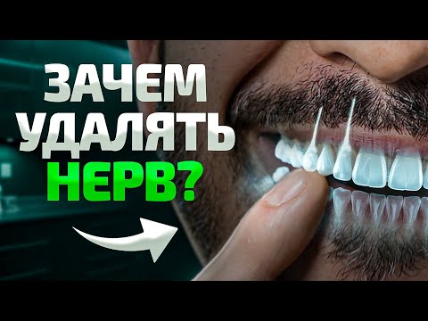 Всё, что нужно знать про удаление зубного нерва. Стоит ли удалять?