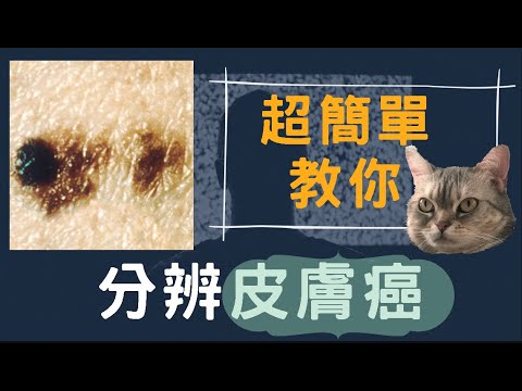 謝霆鋒HughJackman患皮膚癌,醫生教你簡單方法分辨普通痣和皮膚癌?
