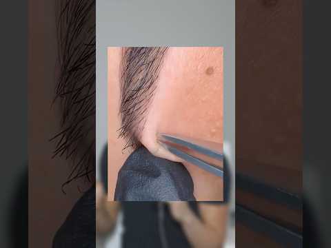 How to remove ingrown hairs 😲