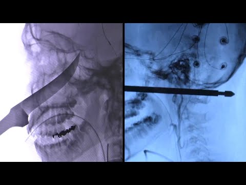 These People Survived Getting Impaled