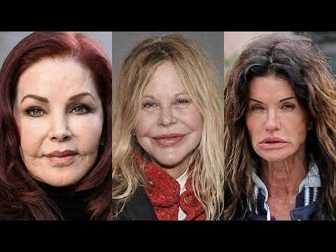 15 Classic Beauties Suffering From Pillow Face | Before and After Photos