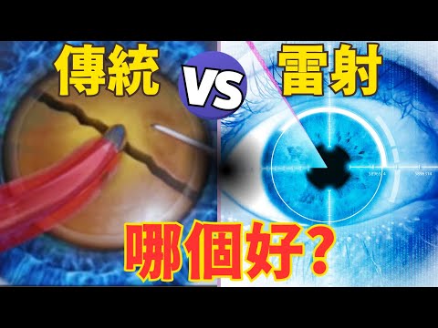 飛秒雷射白內障手術 vs 傳統手術哪個好? 優缺點揭露! 雷射值得多花錢嗎？