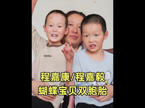 做试管迎来的双胞胎，却两个孩子都是蝴蝶宝贝 @来日可期(嘉毅嘉康蝴蝶宝贝) 嘉毅嘉康妈妈 #蝴蝶宝贝 #纪录片 #妈妈 #母爱 #试管备孕