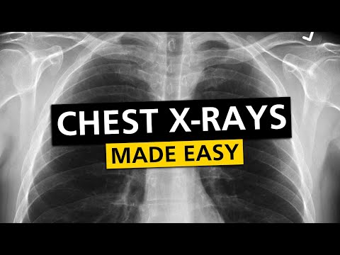 Chest X Rays (CXR) Made Easy! - Learn in 10 Minutes!