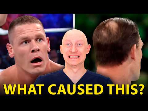 Did John Cena Get A Hair Transplant?