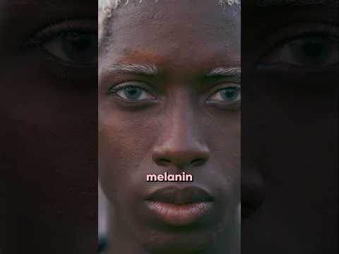 Sunburns! Who Is More At Risk?