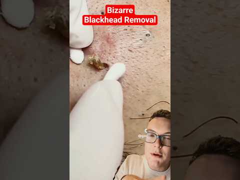Bizarre - SHOCKING BLACKHEAD REMOVAL #shorts