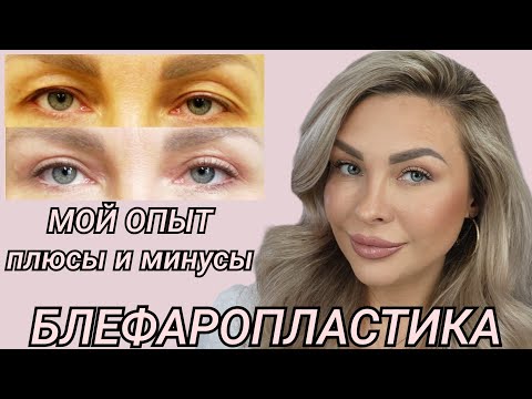 БЛЕФАРОПЛАСТИКА 👁 МОЯ ИСТОРИЯ || МОЙ ОПЫТ|| РЕАБИЛИТАЦИЯ || ПЛЮСЫ И МИНУСЫ