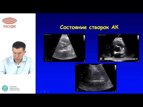 Эхокардиография в диагностике и ведении пороков аортального клапана сердца