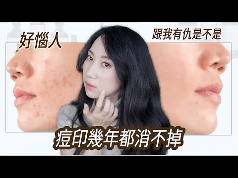 痘印連夜逃跑🏃‍♂️‍➡️超有效淡化全攻略@DrGrace