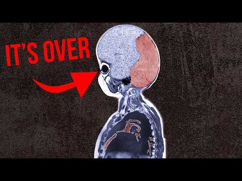 Syphilis Is Evolving Like Never Before.. In Michigan