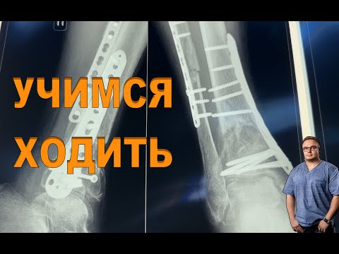 LEARNING TO WALK 3 MONTHS AFTER SURGERY | Tibia Fracture