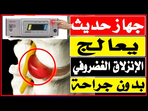 تبخيرالغضروف تقنية حديثة لعلاج الإنزلاق الغضروفي بدون جراحة/د.محمد حمادة أستاذ علاج الألم بطب الازهر