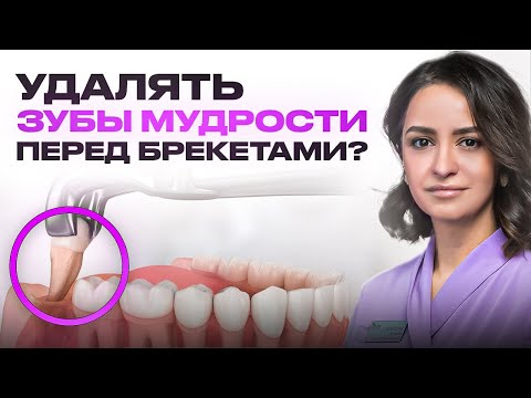 КОГДА НУЖНО УДАЛЯТЬ ЗУБЫ МУДРОСТИ ПЕРЕД БРЕКЕТАМИ?
