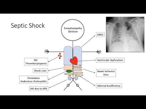 Septic Shock