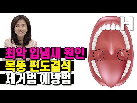 입냄새 원인 목똥 편도결석 제거법 예방법 편도결석도 병인가요?