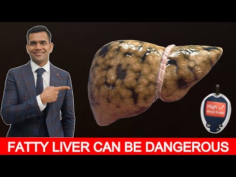 Fatty Liver Treatment | Fastest Way To Recover Fatty Liver  - Dr. Vivek Joshi