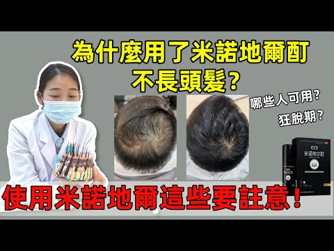脫髮港人必看！生髮藥米諾地爾酊真有用嗎？原理、副作用、注意事項一次性全解析|雍禾植髮醫生黃春花  #生髮