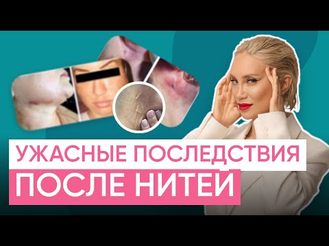 THE WHOLE TRUTH ABOUT THREAD LIFTING!