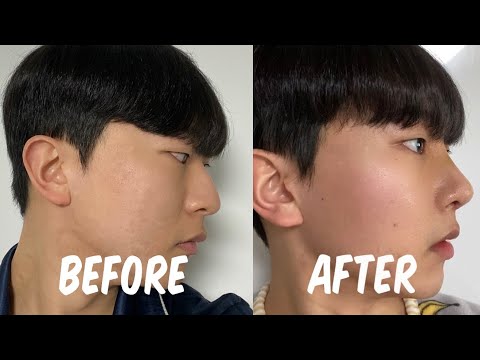 [코수술 VLOG] 👃🏻코수술 1일차부터 7일차까지 • 메부리 • 코끝 • 콧대 • 비중격만곡증 •절골