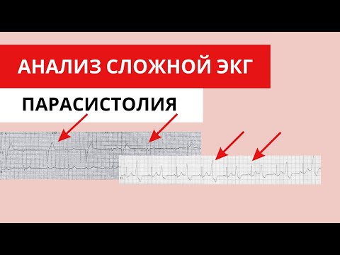 Parasystole or ventricular extrasystoles? Analysis of a complex ECG.