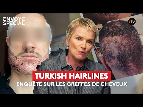 Turkish hairlines, enquête sur la greffe de cheveux - extrait