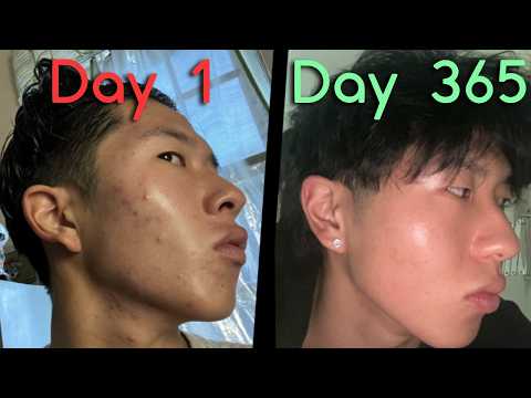 My 1 Year Tretinoin Journey (transformation + tips)