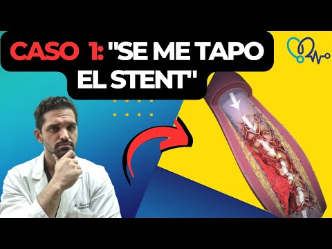 Se me volvio a TAPAR el stent 🤔. Esto puede PASAR!!😳