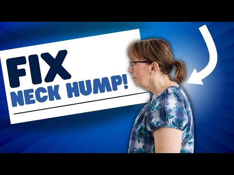 How to Fix Your Neck Hump Fast!