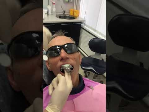 Первичные слепки под all-on-4