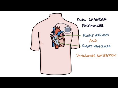 Understanding Pacemakers