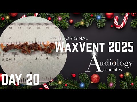 7-Year-Old Hairy Plug Finally Extracted! - Waxvent Day 20