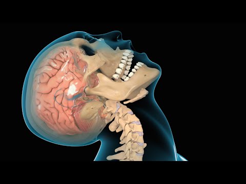 Concussion / Traumatic Brain Injury (TBI) Tua Football Injury