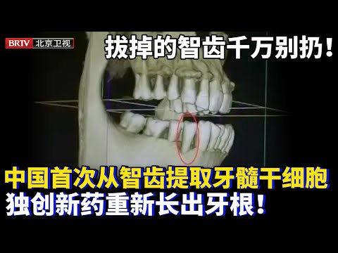 拔掉的智齿千万别扔！中国首次从智齿提取牙髓干细胞，独创新药竟再生牙根！松动的牙齿重新牢固，不可逆的牙周病将成历史！【为你喝彩】