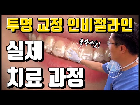투명 교정 인비절라인 효과? 실제 '교정 과정' 공개 (feat.치위생사 사비로 도전)