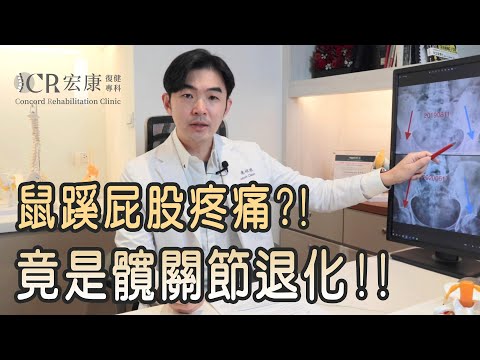 鼠蹊屁股疼痛？！竟是髖關節退化！！